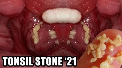 Biggest tonsil stones - sore throat trouble swallowing ear pain ongoing cough swollen tonsils white or yellow debris on the tonsil Smaller tonsil stones may look like white or yellow specks on your tonsils, while...